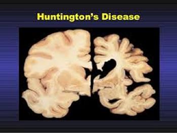 Image result for هانتینگتون