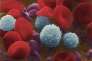 اثبات وجود سلول های بنیادی سرطانی در سندرم  myelodysplastic
