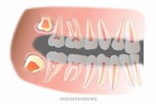 سلول های بنیادی پالپ دندان برای ترمیم ضایعات نخاعی 