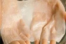 استفاده از پرده آمنیوتیک جنین برای ترمیم پوست دست بیماران eb