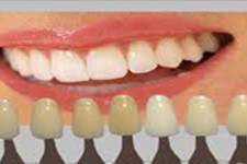 مولکول بتا کاتنین برای تشکیل ریشه دندان مورد نیازاست