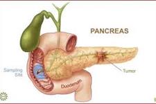 کشف داروی ضد سرطان پانکراس 
