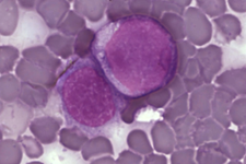 کشف سلول دخیل در تهاجمی شدن سرطان خون