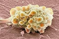 کشف نقش آنزیم ها در تهاجمی شدن سرطان 