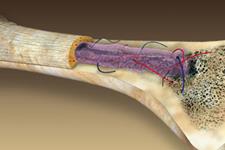 ترمیم استخوان آسیب دیده توسط سازه مهندسی شده بافت برپایه سلول بنیادی 