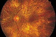 بهبود بینایی در افرادی که با نابینایی لاعلاج متولد می شوند به وسیله ژن درمانی