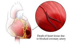 علت جدید بروز  حملات قلبی