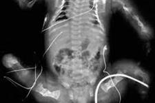 کمک به بهبود شکنندگی استخوان در نوزادان با پیوند سلول های بنیادی جنینی