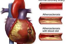 اختلال در جریان خون منجر به تغییرات اپی ژنتیک و آرترواسکلروزیس می شود