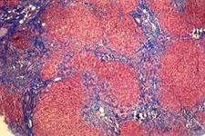 شناسایی منشا سلولی فیبروز