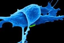 پیش بینی تهاجمی بودن سرطان پروستات