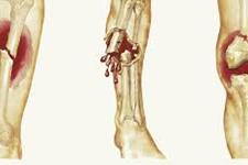 درمان شکستگی های استخوانی بزرگ با استفاده از سلول های بنیادی مزانشیمی
