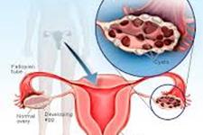 فعالیت فیزیکی به زنان مبتلا به سندرم تخمدان پلی کیستیک کمک می کند
