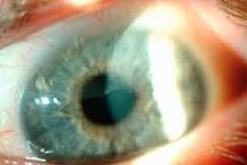 استفاده از پلت فرم eye-on-a-chip برای تست داروهای خشکی چشم