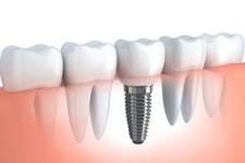بهبود سازش پذیری ایمپلنت های دندانی با استفاده از سلول های بنیادی