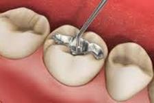 تحریک سلول های بنیادی برای ترمیم دندان ها