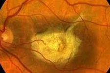 بازبرنامه ریزی سلولی می تواند منجر به درمان بیماری های چشمی شود