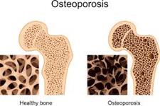سلول های بنیادی می توانند استئوپورز را متوقف کرده و موجب رشد استخوان شوند
