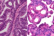 نقش میکروRNAها در متاستاز سرطان پروستات
