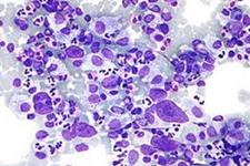بقای پنج ساله کمتر از 40 درصد در افراد مبتلا به لنفومای سلول B بزرگ منتشر(DLBCL)