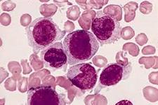 پاسخ سلولی به استرس هدف دارویی امیدوار کننده برای درمان سرطان خون