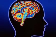 اثبات نقش سلول های پشتیبان مغزی در بیماران هانتینگتونی و ارائه درمان های جدید