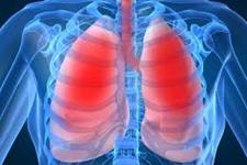 سلول درمانی امیدی برای بیماران مبتلا به آسم و COPD