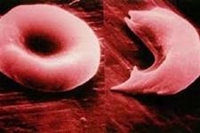 جلوگیری از درمان هایی برای سرطان و بیماری کم خونی داسی شکل که سلول های زایا را در پسربچه های جوان تخریب می کنند