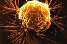 نوتروفیل ها از کلونی زایی سلول های متاستاز کننده سرطان سینه حمایت می کنند