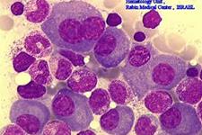 استفاده از سلول های کشنده ذاتی مشتق از خون بند ناف برای درمان بیماران مبتلا به مولتیپل میلوما