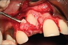 فعال شدن سیگنالینگ Wnt در سلول های بنیادی دندانی بعد از تولد می تواند منجر به تشکیل ادونتوما شود