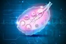 شناسایی یک درمان ترکیبی بالقوه برای سرطان تخمدان