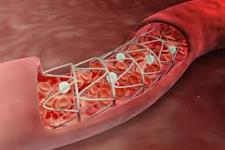 هم کشتی سلول های اندوتلیالی ترانسفکت شده با سلول های شریانی برای جلوگیری از بیماری رستنوز(restenosis)