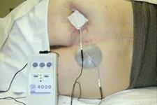 تحریک الکتریکی جایگزینی برای آنتی بیوتیک ها در درمان زخم