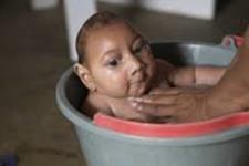 مبتلا شدن جنین موش آلوده به زیکا به میکروسفالی