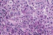جمع آوری بزرگ ترین منبع سلول های بنیادی مشتق از بیماران مبتلا به نقص آلفا-1 آنتی تریپسین(AATD)