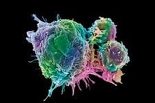 استفاده از سلول های CAR T در درمان مولتیپل میلوما