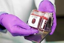 فاز یک کارآزمایی بالینی با پیوند هم زمان خون بند ناف و سلول های بنیادی مزانشیمی 