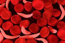 موفقیت ژن درمانی برای فرد مبتلا به بیماری کم خونی داسی شکل