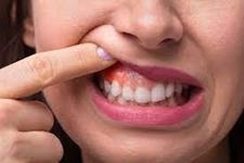 در خصوص سرطان دهان چه می‌دانید؟