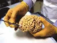 پیش بینی خطر ابتلا به بیماری آلزایمر براساس حجم مغز