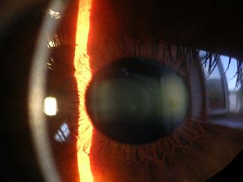 سلول های بنیادی بند ناف ممکن است بینایی از دست رفته در بیماری های قرنیه را بازگرداند