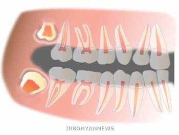 سلول های بنیادی پالپ دندان برای ترمیم ضایعات نخاعی 