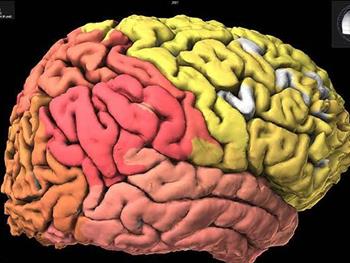 استفاده از سلول های بنیادی عصبی در درمان سکته مغزی