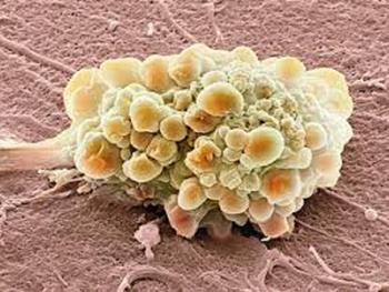 کشف نقش آنزیم ها در تهاجمی شدن سرطان 