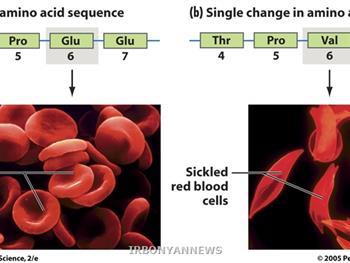 کم‌خونی سلول‌های قرمز داسی‌شکل