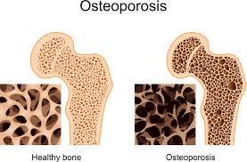 سلول درمانی با اثرات پوکی استخوان ناشی از استئوپورز مقابله می کند
