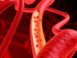 محققین ارتباط بالقوه ای را بین چربی خون و ریکاوری عروق خونی در ایسکمی یافته اند