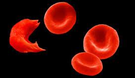 پیوند سلول های بنیادی برای معالجه بالغین مبتلا به کم خونی داسی شکل