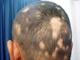 رشد مجدد مو در بیماران آلوپسی آره آتا به دنبال سلول درمانی